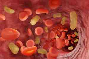 Rises in the Threat of Sepsis